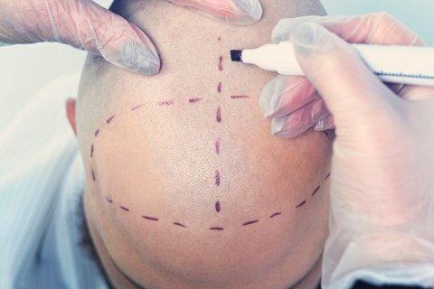 Hair Transplant in 20 Questions 4