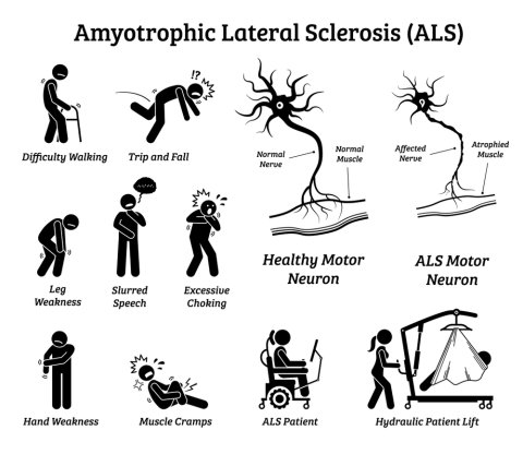 What is ALS? What are the stages and causes of ALS? 3